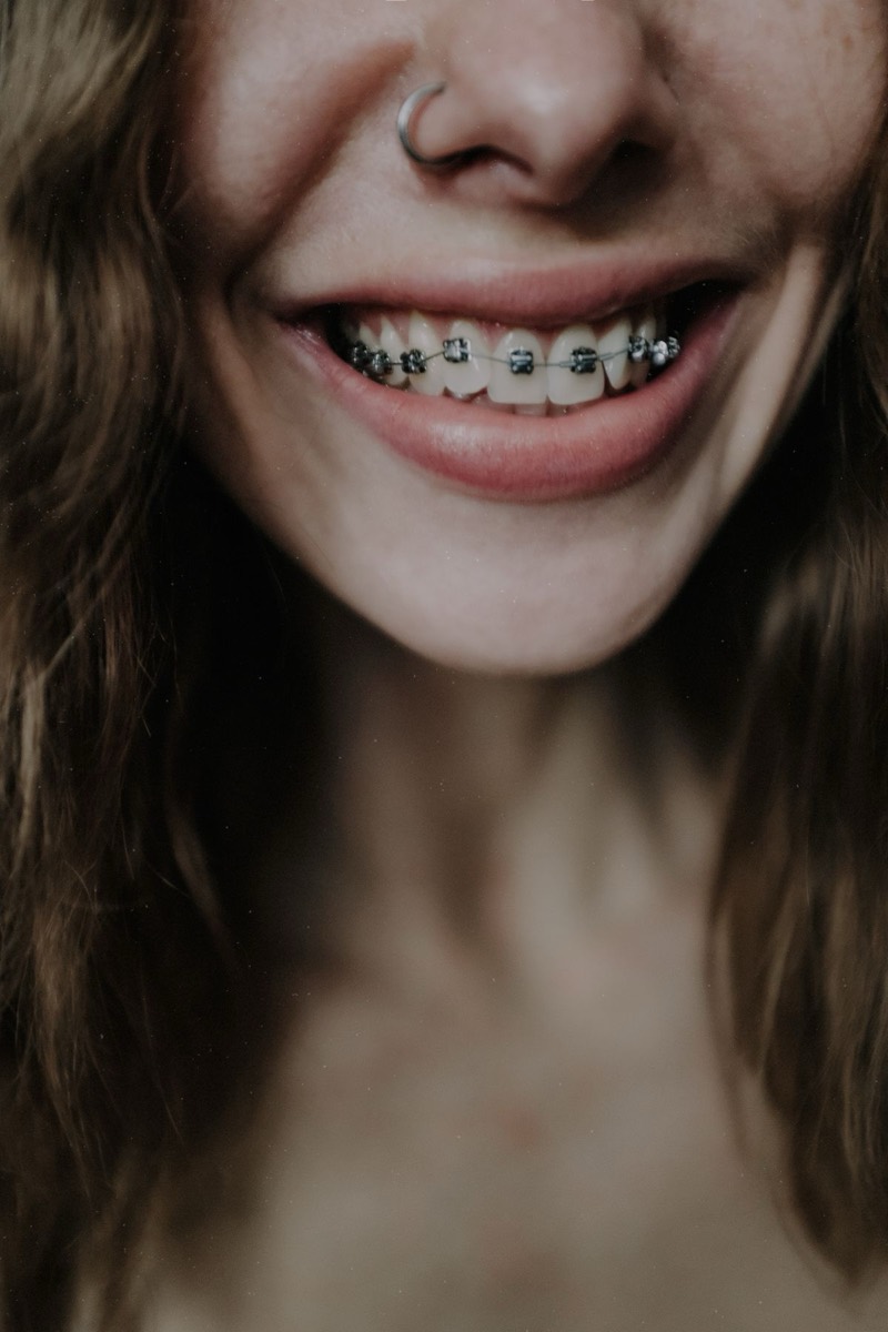 Smiling patient showing dental braces on teeth