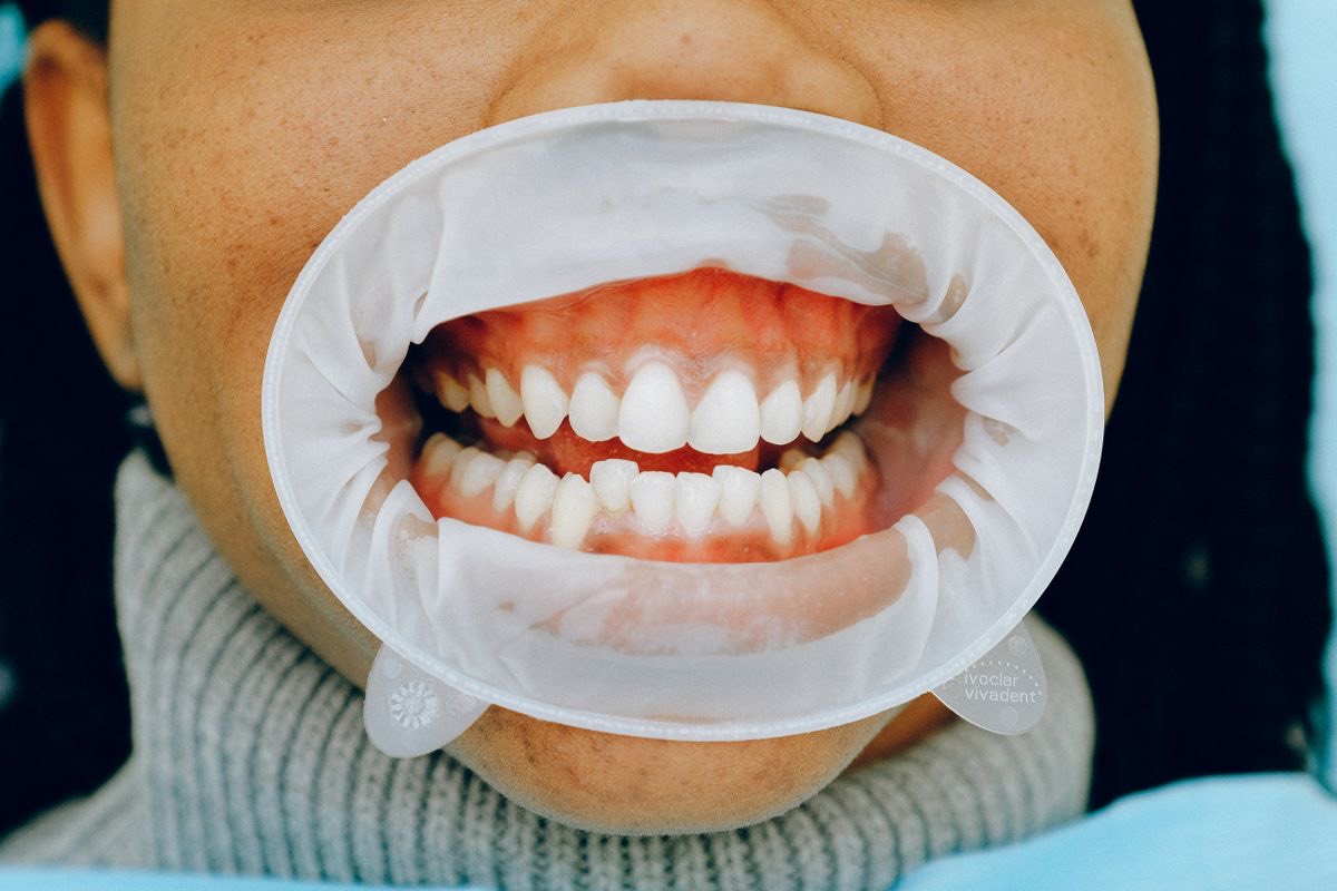 Dental examination with mouth retractor to assess tooth condition